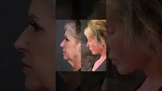 Incredible Transformation: Before and After Face and Neck Lift by Dr. Paul Nassif!