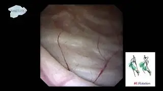 No-Touch Technique