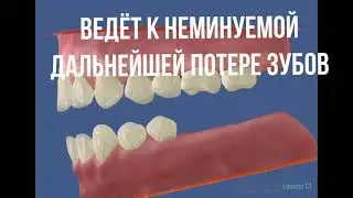 Неполный зубной ряд приводит к дальнейшей потере зубов