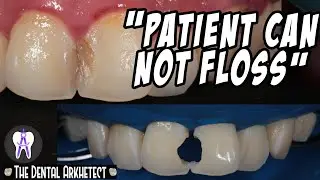 Kissing Cavity Restoration Explanation 