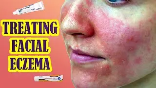 Effective Treatments For Eczema On The Face | Topical Steroids or Tacrolimus