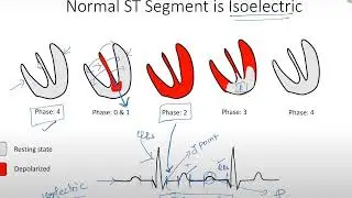 ecg 6