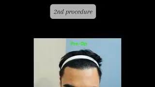 5 MONTHS post 2ND Hair transplant PROCEDURE Update - Motion Hair Clinic, Gangnam