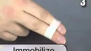 How to Treat a Jammed Finger or Toe
