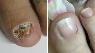 From Icky Toes to Pretty Summer Toes ! Here's How
