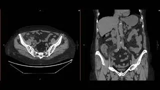Abdominal Imaging Call Prep Cases: Acute Uncomplicated Appendicitis (CT) Case 3 Discussion