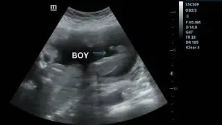Ultrasound showing boy baby !!!🤰 | 23 weeks