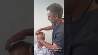 9 Months After 1300 FUE Hair Transplant | Anthony Bared MD, FACS | Miami, FL