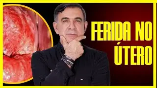 ASSISTA ESTE VÍDEO ANTES DE REALIZAR A CAUTERIZAÇÃO DO COLO DO ÚTERO - [FERIDA / ECTOPIA]