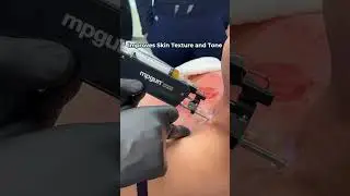 PRP with Preventous cosmetic medicine! #prp #prptreatment