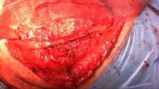 Male rectus diastasis with narrow retrorectus mesh and mesh strips