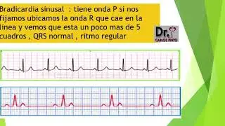 INTERPRETACION DEL ELECTROCARDIOGRAMA EN URGENCIAS parte final