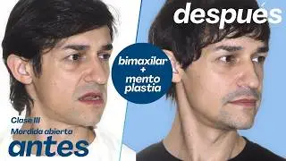 Cirugía bimaxilar Caso #151: Gastón- Clase III,  mordida abierta