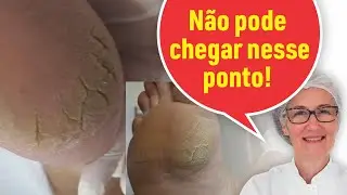 PÉ COM MUITAS RACHADURAS PROFUNDAS
