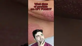 Where do people FORGET TO CHECK with psoriasis ?