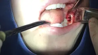 VLOG ODONTO: EXTRAÇÃO DOS SISOS SEM CORTES! (CENAS FORTES)