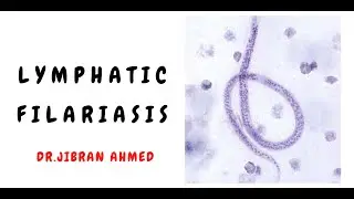 LYMPHATIC FILARIASIS II INFECTIONS II SIMPLY PATHOLOGY II POST GRADUATE EDUCATION II