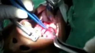 Bloodless tonsillectomy by bipolar cautery method : Dr Arfat Jawaid
