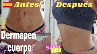 DERMAPEN PARA LAS ESTRIAS  COMO HACER Desde su casa