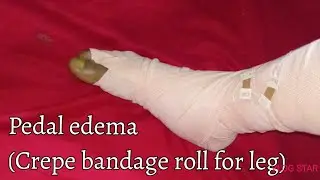 pedal edema in tamil|Experiences of cause,treatment,medications|crepe bandage roll for leg