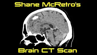 Shane's Brains! CT Scan - September 2023