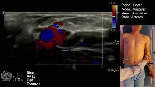 Vascular Doppler using Ultrasound Made Simple