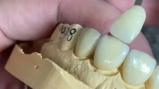 How to Make Full Shape Emax Veneers Look More Alive