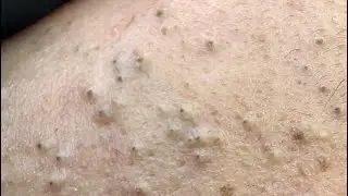 Ultimate Blackhead And Pimple Removal — Clear Complexion