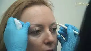 Пересадка бровей в клинике Gold Laser