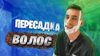 ПЕРЕСАДКА ВОЛОС В ТУРЦИИ. ПЕРЕЖИЛ НА СЕБЕ ЧТОБЫ ПОКАЗАТЬ ВАМ.