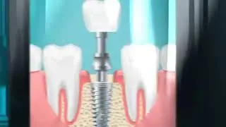 Planes odontológicos - implantes dentales