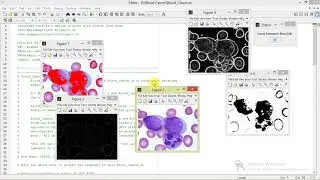 Leukemia Cancer Detection Using Matlab