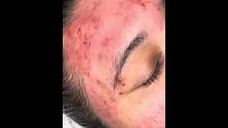 #extractionsatisfaciton #extractions zoom extractions face