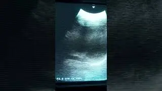 Female heart, breathplay, ultrasonic device, heartbeat sound
