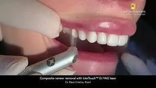 Composite veneer removal with LiteTouch™ Er:YAG laser