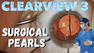 Cataract Surgery Pearls with the Clearview 3 Lens Implant