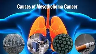 mesothelioma commercial guy