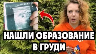 У ЖЕНИ НАШЛИ ОБРАЗОВАНИЕ В ГРУДИ