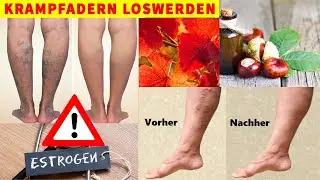 What really helps with varicose veins? 5 natural remedies!