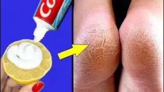 Spread toothpaste on your feet and thank me later