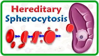 Hereditary Spherocytosis #medicine #davidson