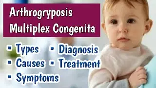 Arthrogryposis Multiplex Congenita AMC | Multiple Newborn Joint Contractures at Birth