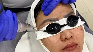 Viral ‼️ Cara Hapus Sulam Alis Paling Ampuh