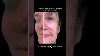 Scar Revision after Mohs Surgery on Cheek Using Skin Graft and Advancement Flap | Dr. Khorasani NYC