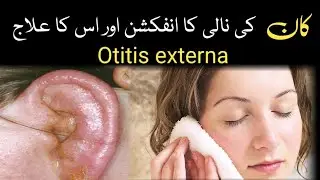 Otitis externa symptoms causes and treatment/kan ki nali ka infection