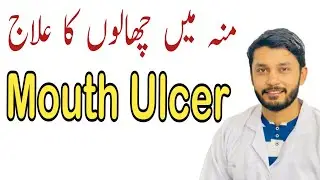 Mouth Ulcer Cases & Treatment|منہ میں چھالوں کا علا