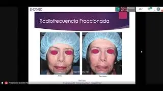 Dra  Alejandra Builes - ENDYMED Live Training