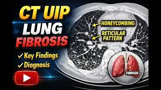 Decoding UIP pattern lung fibrosis