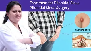 Treatment for Pilonidal Sinus | Pilonidal Sinus Surgery | Dr Hardeep Bains #PilonidalSinus