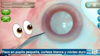 Pupila pequeña, catarata blanca y núcleo café en facoemulsificación